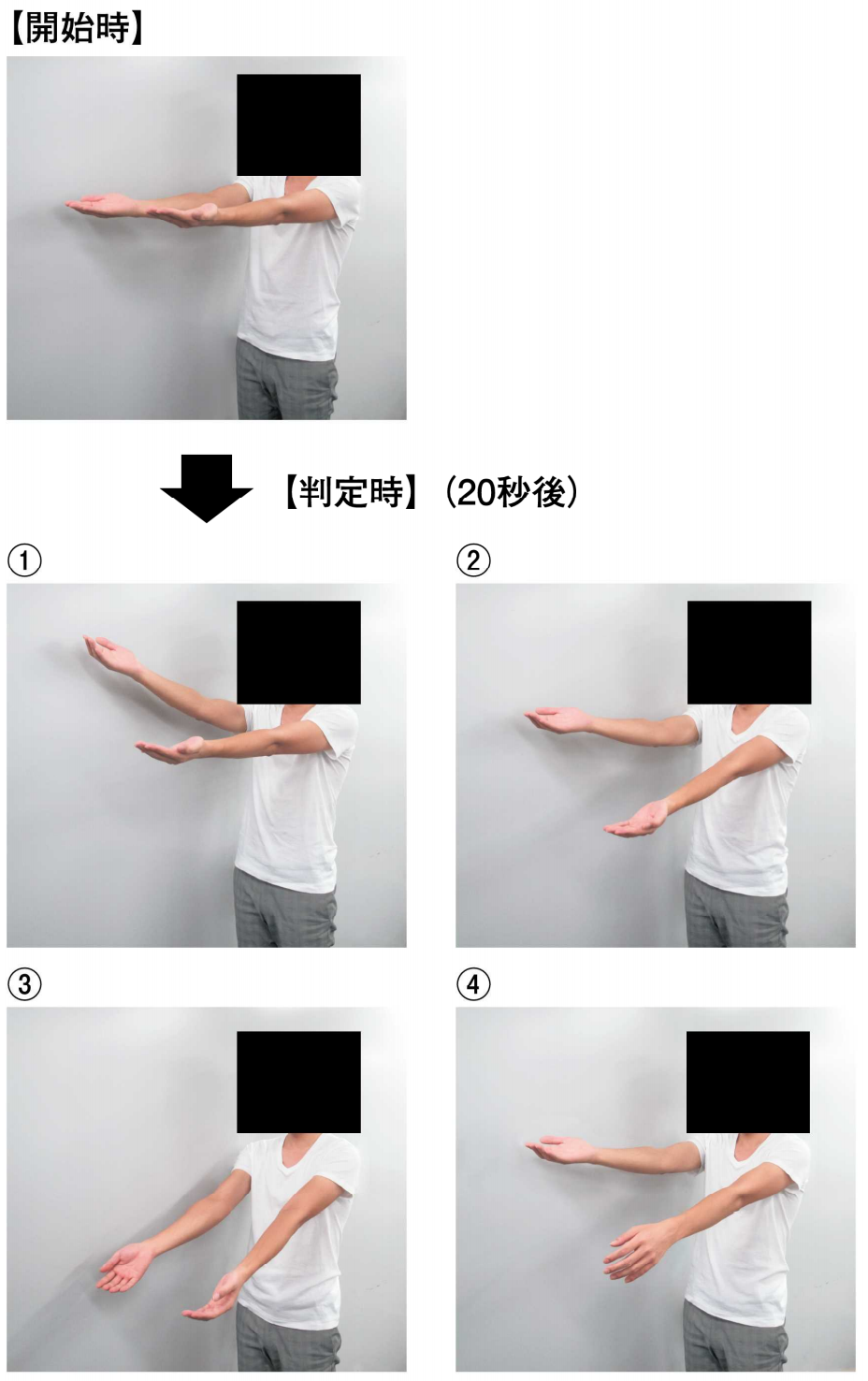 Barré＜バレー＞徴候の査定の開始時と判定時の写真を別に示す。 左上肢の Barré＜バレー＞徴候陽性を示すのはどれか。