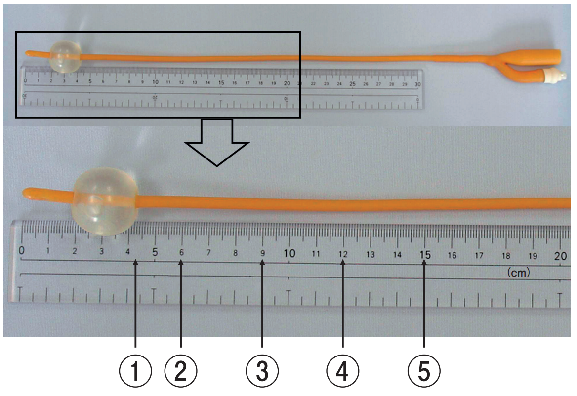 膀胱留置カテーテルの写真を別に示す。 成人女性に膀胱留置カテーテルが挿入されている場合、体内に留置されている長さで