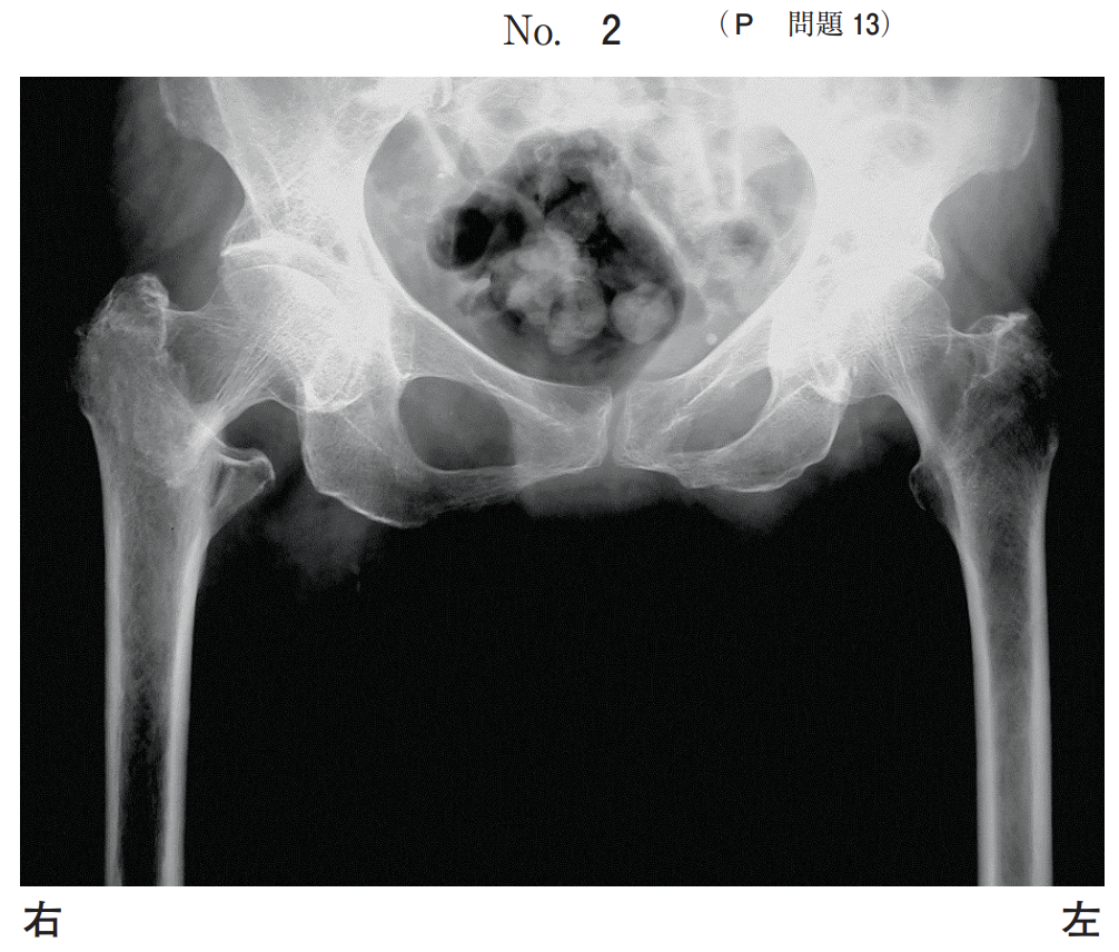 歳の女性 転倒して右股関節痛を訴えた エックス線写真 別冊no 2 を別に示す 疑うべき疾患はどれか