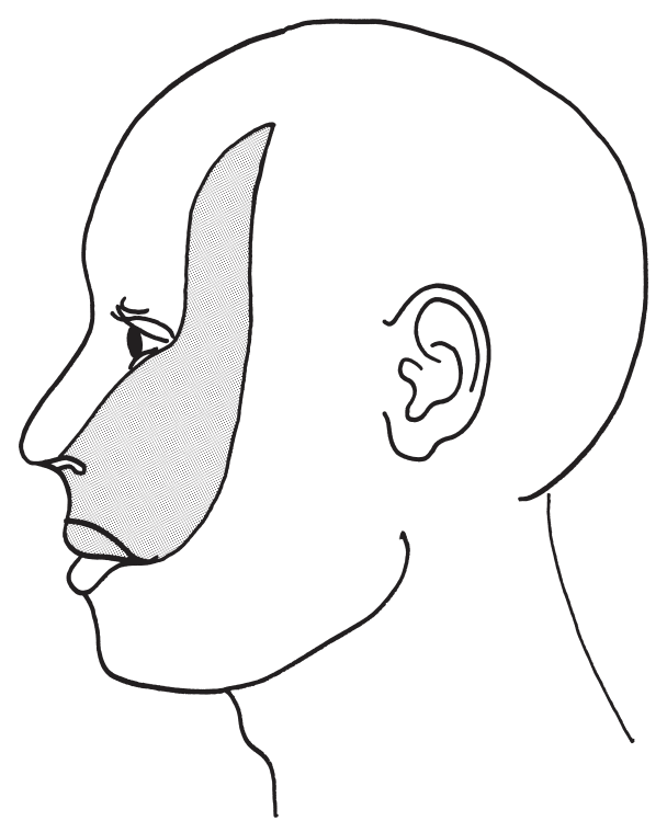 左顔面を図に示す 網かけ部分を支配している感覚神経はどれか